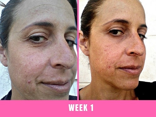 Beauty LED Face Before and (30 Days)