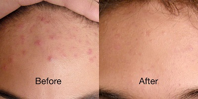 revive light therapy for acne before and after