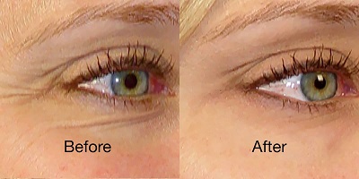 revive light therapy eye wrinkle results