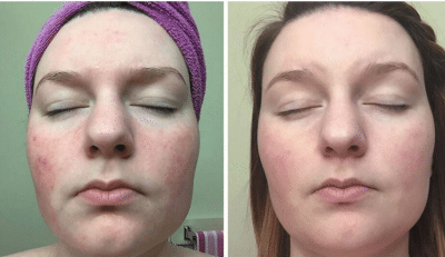 purple light therapy before and after