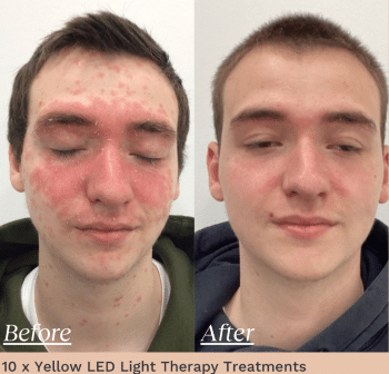 yellow light therapy before and after